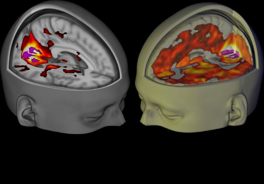 lsd study effects on the brain